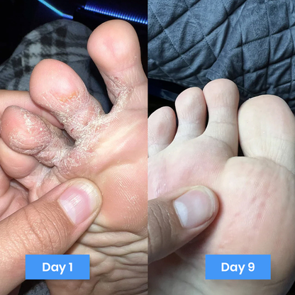 New Aura™ Anti-Fungal Foot Cream
