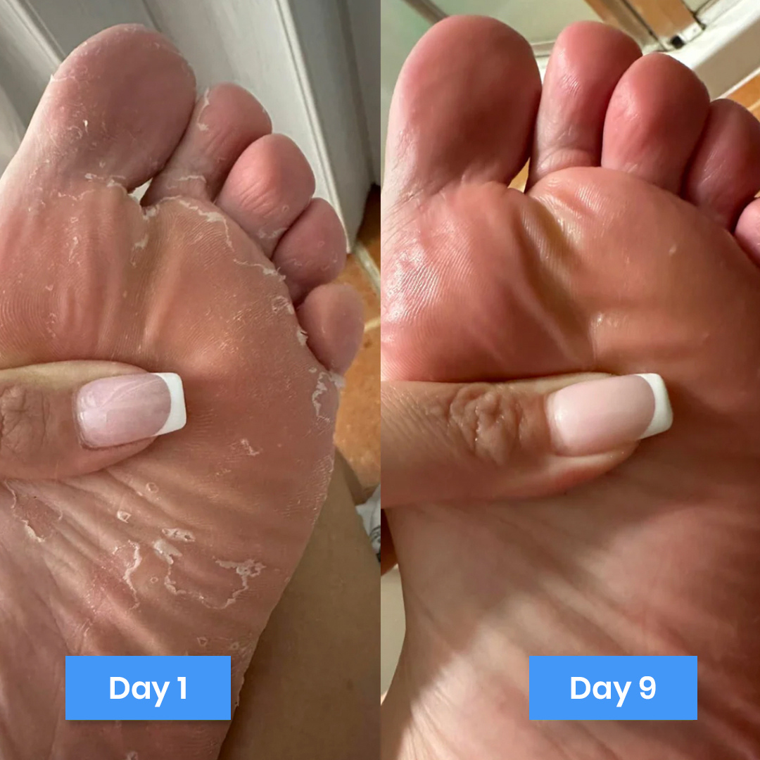 New Aura™ Anti-Fungal Foot Cream