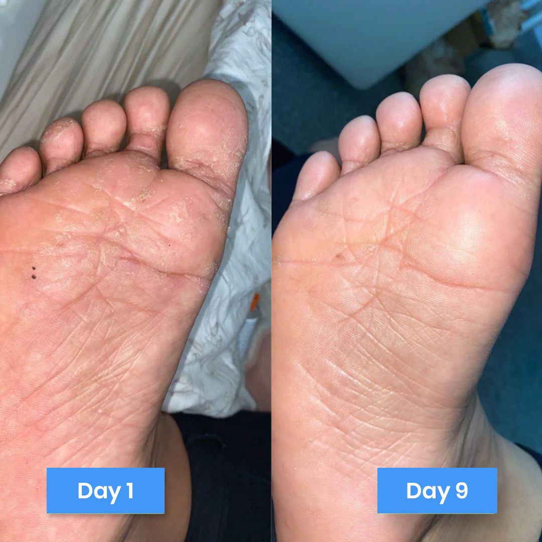 New Aura™ Anti-Fungal Foot Cream