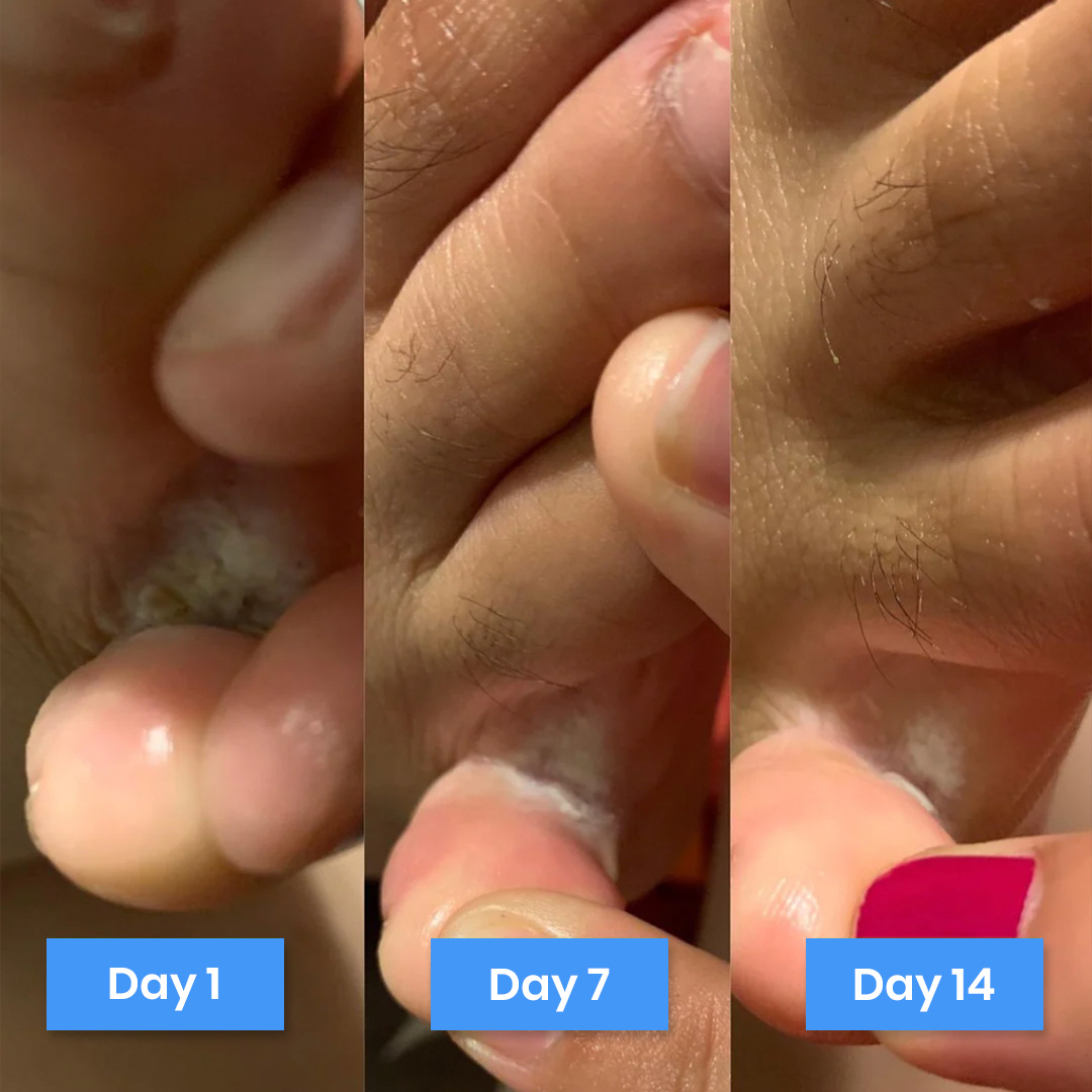 New Aura™ Anti-Fungal Foot Cream