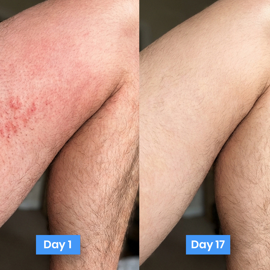 New Aura™ Anti-Fungal Jock Cream USA