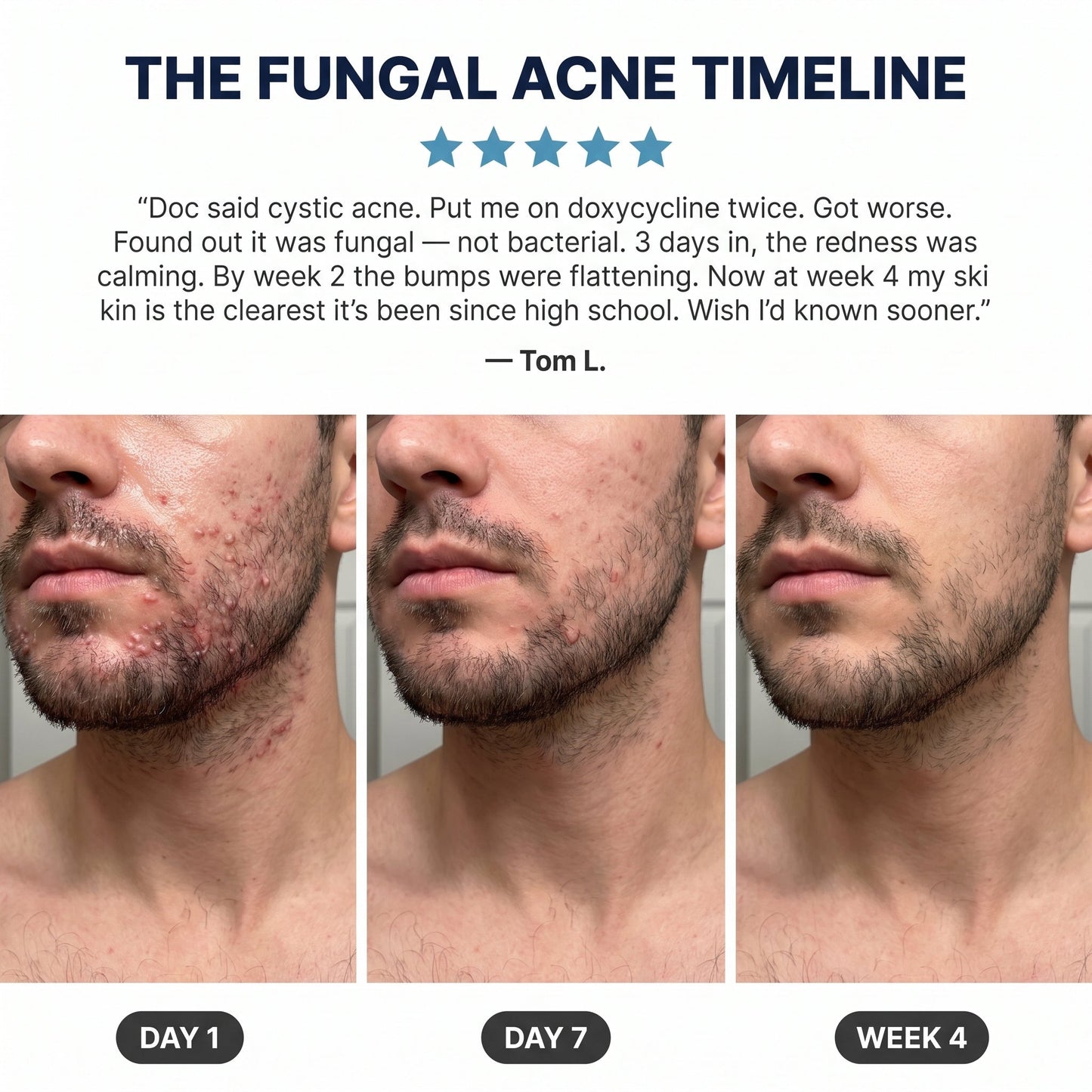 New Aura™ Men's Anti-Fungal Acne Cream